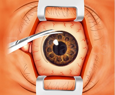 Anophthalmos Surgery — Step-by-Step — Enucleation — slide 1 of 16