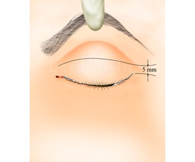 Blepharoplasty Surgery — Step-by-Step — Upper — slide 1 of 9