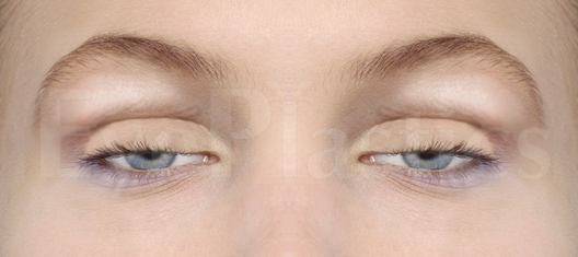 Ptosis Repair — With vs. Without Blepharoplasty — view A, slide 1 of 6