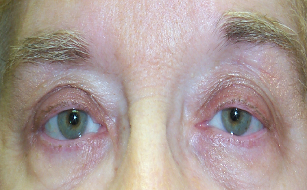 Visual Field Loss from Ptosis — slide 1 of 8