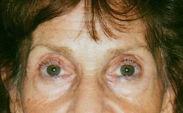 Case 17 before