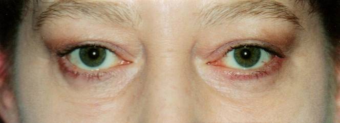 Case 30 after