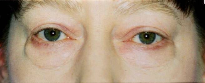 Case 30 before