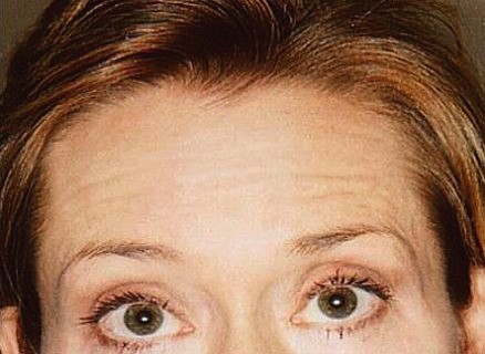 Case 31 after