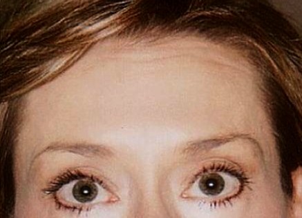 Case 31 before