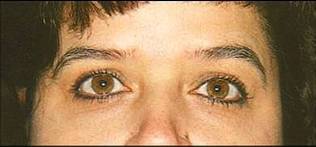 Case 32 after