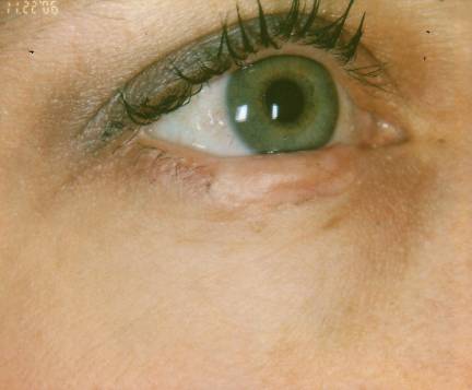 Case 46 after