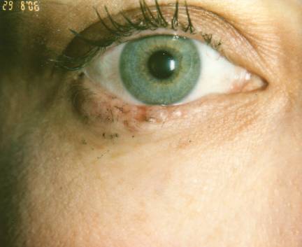 Case 46 before
