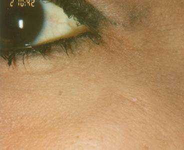 Case 48 before