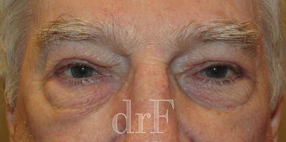 Case 14 after